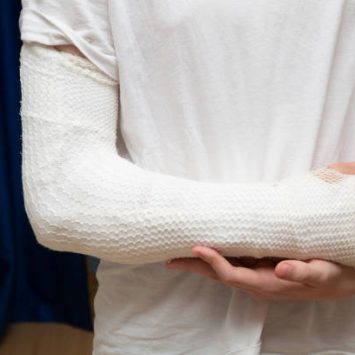 fracture